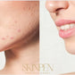 SkinPen Professionnel